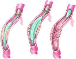 Percutaneous Coronary Intervention
