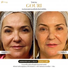 Gouri Collagen PCL 21% สร้างคอลลาเจนอย่างยั่งยืน เปลี่ยนผิวเก่าเป็นผิวใหม่