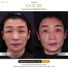 Gouri Collagen PCL 21% สร้างคอลลาเจนอย่างยั่งยืน เปลี่ยนผิวเก่าเป็นผิวใหม่