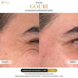 Gouri Collagen PCL 21% สร้างคอลลาเจนอย่างยั่งยืน เปลี่ยนผิวเก่าเป็นผิวใหม่