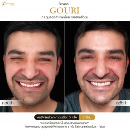 Gouri Collagen PCL 21% สร้างคอลลาเจนอย่างยั่งยืน เปลี่ยนผิวเก่าเป็นผิวใหม่