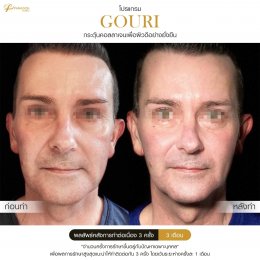 Gouri Collagen PCL 21% สร้างคอลลาเจนอย่างยั่งยืน เปลี่ยนผิวเก่าเป็นผิวใหม่