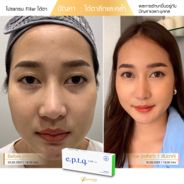 Review Filler ใต้ตา