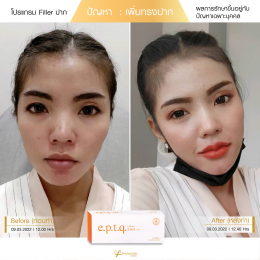 Review Filler ปาก