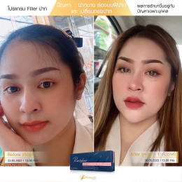 Review Filler ปาก