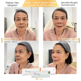 Review Filler ปรับรูปหน้า