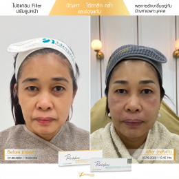 Review Filler ปรับรูปหน้า