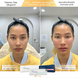 Review Filler ปรับรูปหน้า