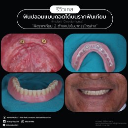 รากฟันเทียม