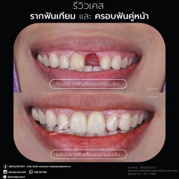 รากฟันเทียม