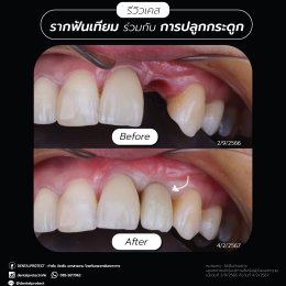 รากฟันเทียม