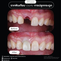 รากฟันเทียม