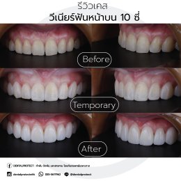 วีเนียร์