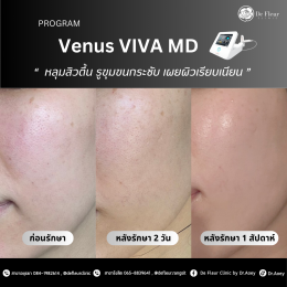 Venus VIVA MD ครบจบทุกปัญหาผิว ต้องเครื่องนี้เท่านั้น เครื่องเดียวในรังสิต