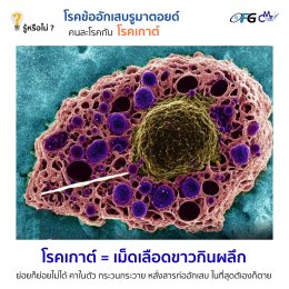 รู้หรือไม่ ? โรคข้ออักเสบรูมาตอยด์ คนละโรคกับโรคเกาต์