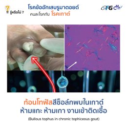รู้หรือไม่ ? โรคข้ออักเสบรูมาตอยด์ คนละโรคกับโรคเกาต์