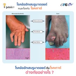 รู้หรือไม่ ? โรคข้ออักเสบรูมาตอยด์ คนละโรคกับโรคเกาต์