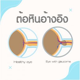 " ต้อหิน "