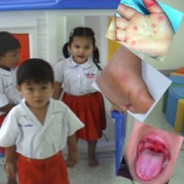 โรคแผลในปากและมือเท้าปาก