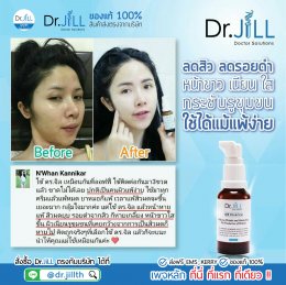 Dr JiLL รีวิว ผลการใช้จริง *สงวนสิทธิ์การนำภาพไปใช้โดยไม่ได้รับอนุญาต