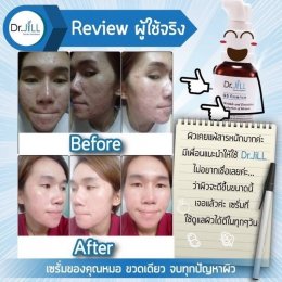 Dr JiLL รีวิว ผลการใช้จริง *สงวนสิทธิ์การนำภาพไปใช้โดยไม่ได้รับอนุญาต