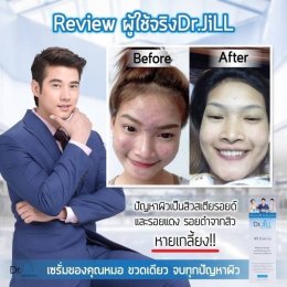 Dr JiLL รีวิว ผลการใช้จริง *สงวนสิทธิ์การนำภาพไปใช้โดยไม่ได้รับอนุญาต