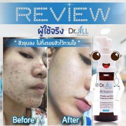 Dr JiLL รีวิว ผลการใช้จริง *สงวนสิทธิ์การนำภาพไปใช้โดยไม่ได้รับอนุญาต