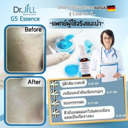 Dr JiLL รีวิว ผลการใช้จริง *สงวนสิทธิ์การนำภาพไปใช้โดยไม่ได้รับอนุญาต