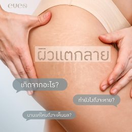 ผิวแตกลาย เกิดจากอะไร??