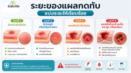 แผลกดทับเริ่มต้นหน้าตาเป็นอย่างไร? ระยะอันตราย + ต้องพบแพทย์เมื่อไหร่?