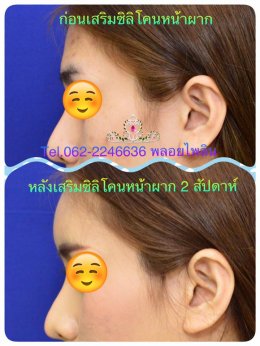 รีวิวเสริมหน้าผาก