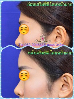 รีวิวเสริมหน้าผาก