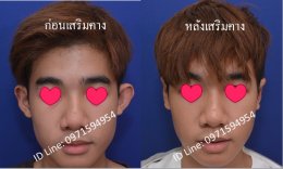 แก้ไขหูกาง1