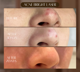 ACNE BRIGHT LASER