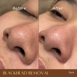 NOSE BLACKHEAD REMOVAL