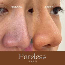 PORELESS SKIN