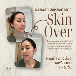 SKIN OVER