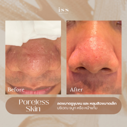 PORELESS SKIN