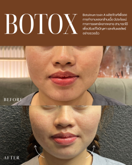 BOTOX