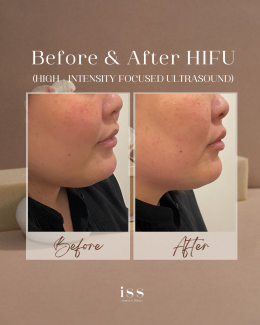 HIFU (High-Intensity Focused Ultrasound)