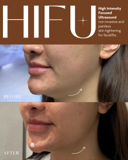 HIFU (High-Intensity Focused Ultrasound)