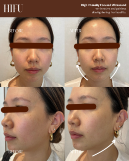 HIFU (High-Intensity Focused Ultrasound)