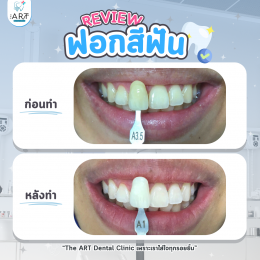 เคสรีวิว