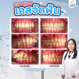 เคสรีวิว