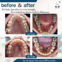 เคสรีวิว