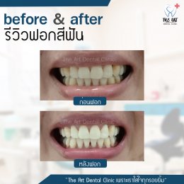 เคสรีวิว