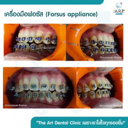 เคสรีวิว