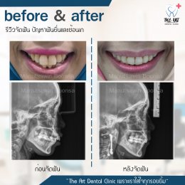 เคสรีวิว