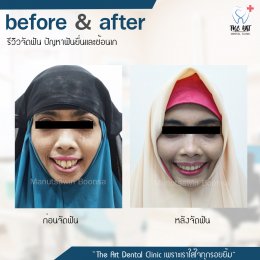 เคสรีวิว