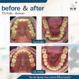 เคสรีวิว